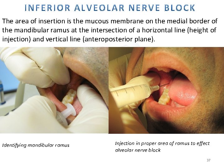 The area of insertion is the mucous membrane on the medial border of the