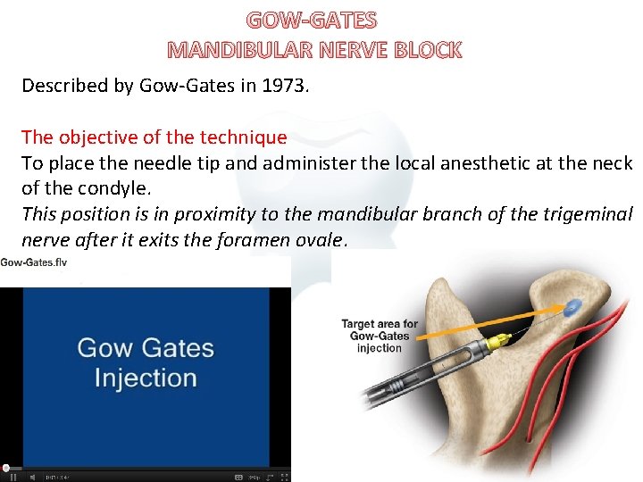 GOW-GATES MANDIBULAR NERVE BLOCK Described by Gow-Gates in 1973. The objective of the technique