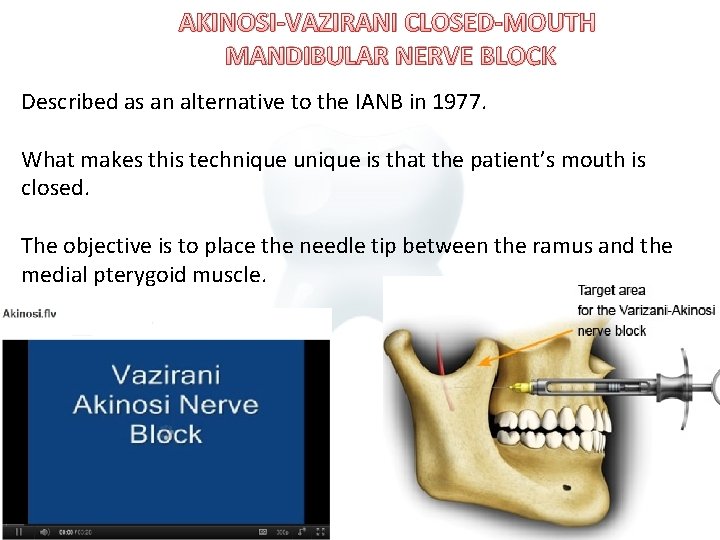AKINOSI-VAZIRANI CLOSED-MOUTH MANDIBULAR NERVE BLOCK Described as an alternative to the IANB in 1977.