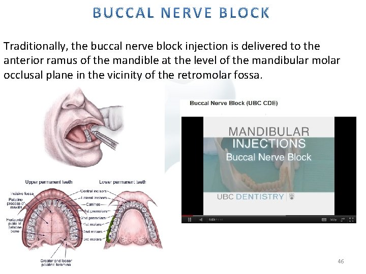 Traditionally, the buccal nerve block injection is delivered to the anterior ramus of the