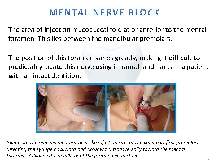 The area of injection mucobuccal fold at or anterior to the mental foramen. This