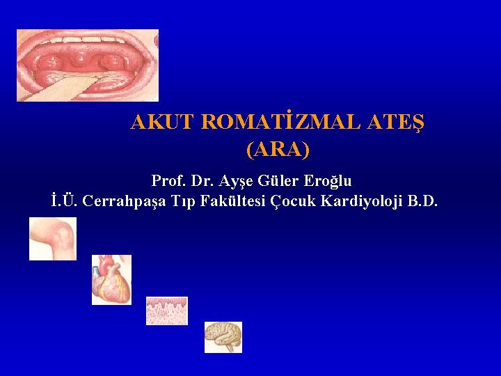 AKUT ROMATİZMAL ATEŞ (ARA) Prof. Dr. Ayşe Güler Eroğlu İ. Ü. Cerrahpaşa Tıp Fakültesi