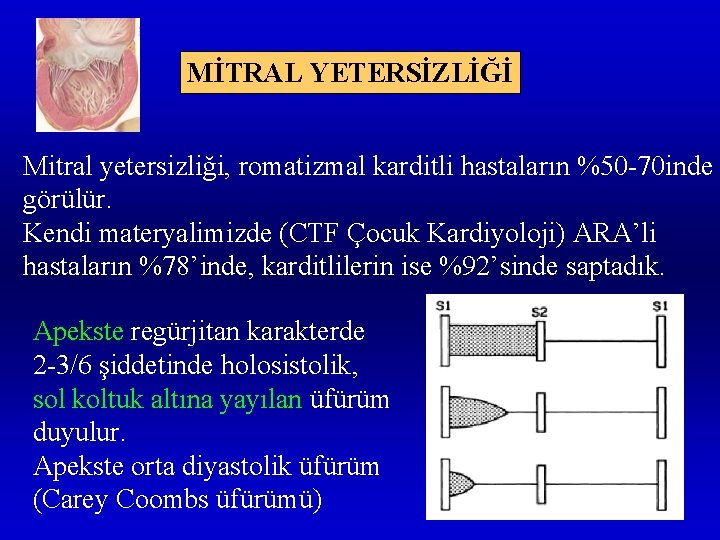 MİTRAL YETERSİZLİĞİ Mitral yetersizliği, romatizmal karditli hastaların %50 -70 inde görülür. Kendi materyalimizde (CTF