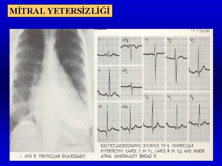 MİTRAL YETERSİZLİĞİ 
