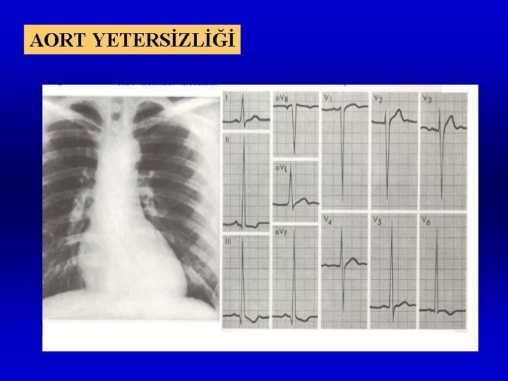 AORT YETERSİZLİĞİ 