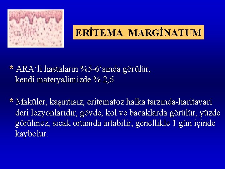 ERİTEMA MARGİNATUM * ARA’li hastaların %5 -6’sında görülür, kendi materyalimizde % 2, 6 *