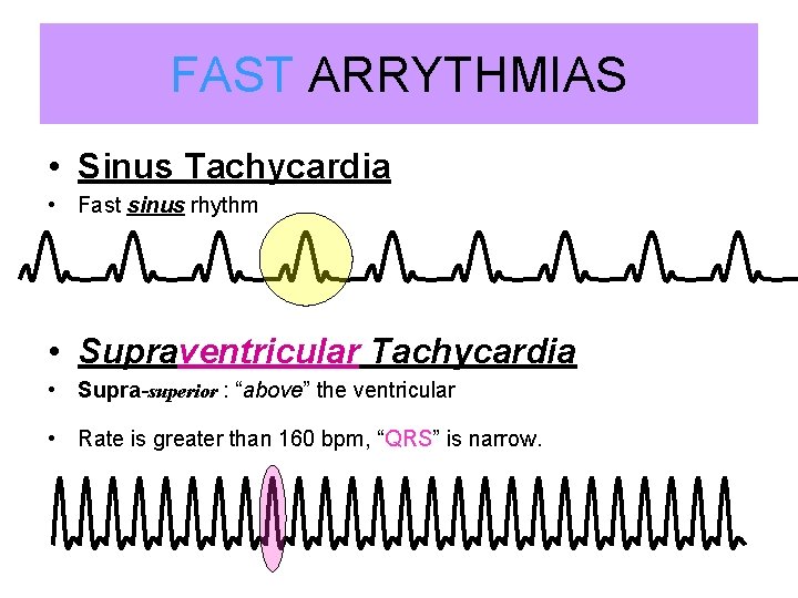 FAST ARRYTHMIAS • Sinus Tachycardia • Fast sinus rhythm • Supraventricular Tachycardia • Supra-superior