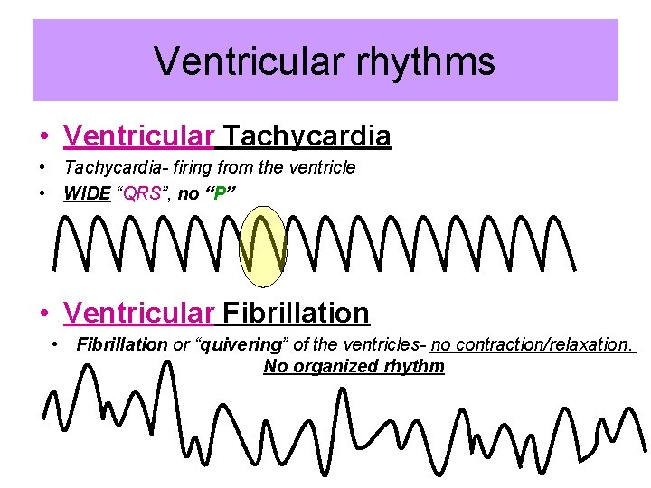 Ventricular rhythms • Ventricular Tachycardia • Tachycardia- firing from the ventricle • WIDE “QRS”,