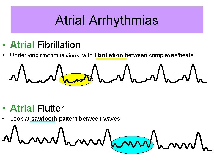 Atrial Arrhythmias • Atrial Fibrillation • Underlying rhythm is sinus, with fibrillation between complexes/beats