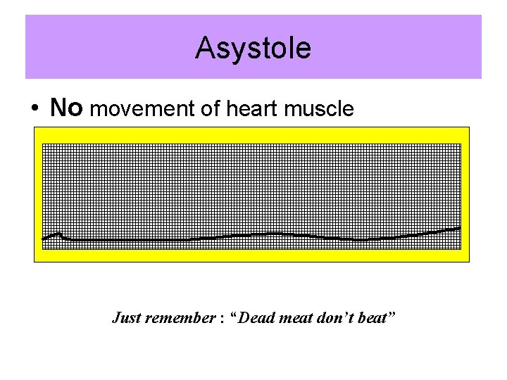 Asystole • No movement of heart muscle Just remember : “Dead meat don’t beat”