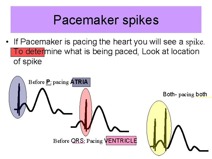 Pacemaker spikes • If Pacemaker is pacing the heart you will see a spike.