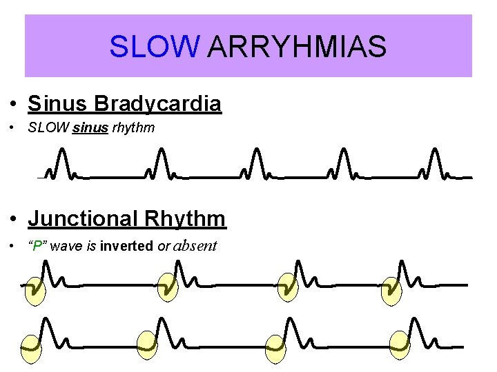 SLOW ARRYHMIAS • Sinus Bradycardia • SLOW sinus rhythm • Junctional Rhythm • “P”