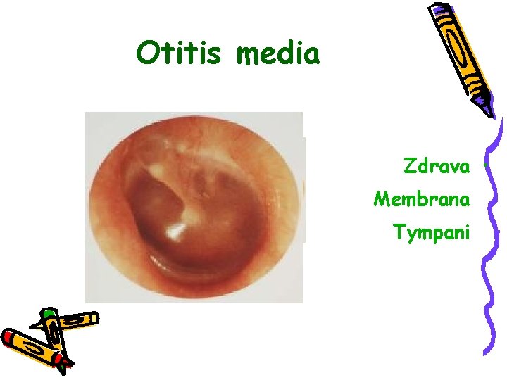 Otitis media Zdrava • Membrana Tympani 