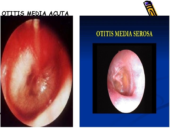 OTITIS MEDIA ACUTA 