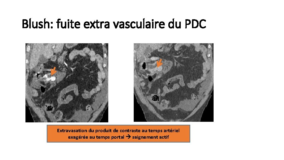 Guide dinterprtation du scanner dans le traumatisme abdominal