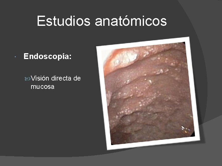 Estudios anatómicos Endoscopía: Visión directa de mucosa 