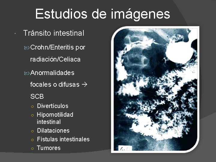 Estudios de imágenes Tránsito intestinal Crohn/Enteritis por radiación/Celiaca Anormalidades focales o difusas SCB ○