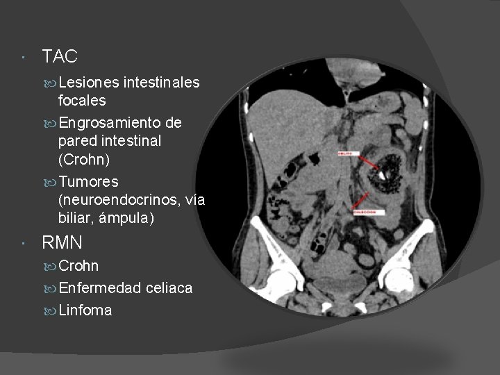  TAC Lesiones intestinales focales Engrosamiento de pared intestinal (Crohn) Tumores (neuroendocrinos, vía biliar,