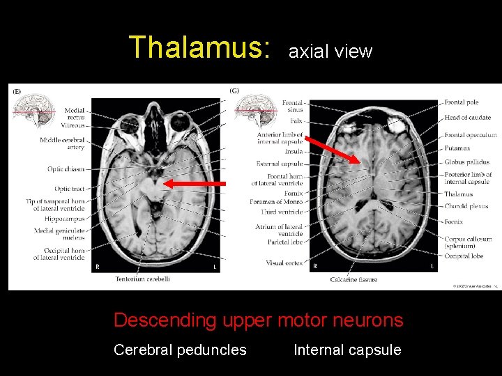 Thalamus: axial view Descending upper motor neurons Cerebral peduncles Internal capsule Thalamus: axial view Descending upper motor neurons Cerebral peduncles Internal capsule