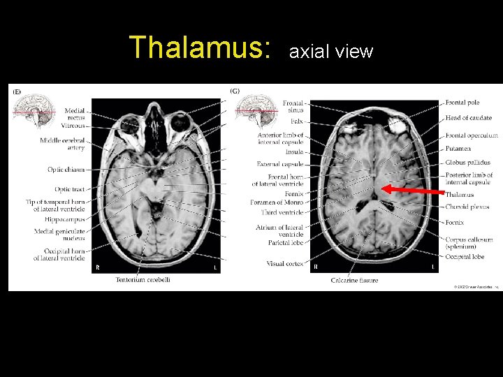 Thalamus: axial view 