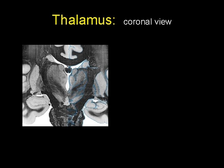 Thalamus: coronal view 