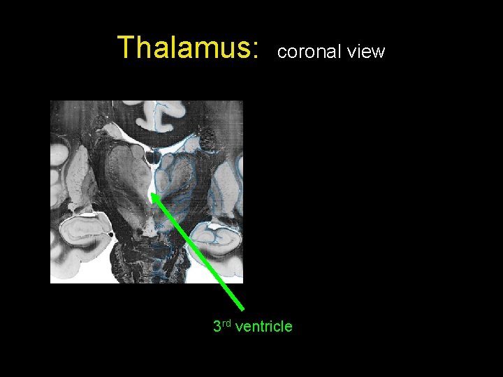 Thalamus: coronal view 3 rd ventricle 