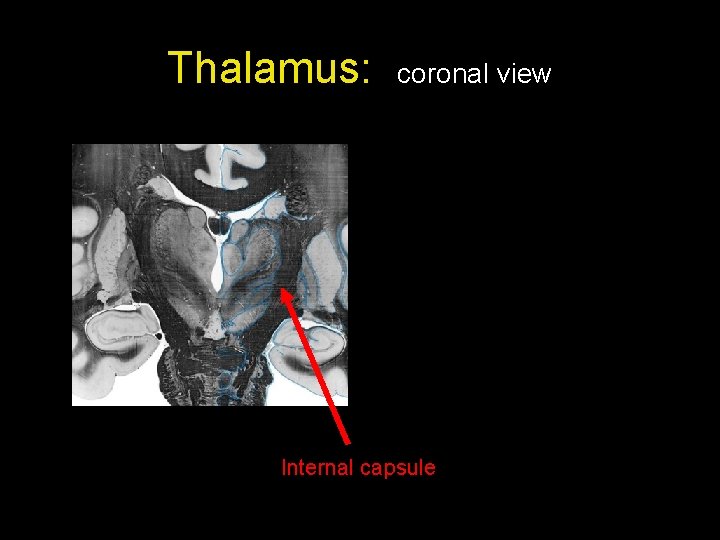Thalamus: coronal view Internal capsule 