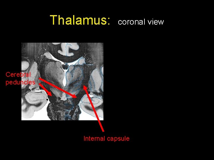 Thalamus: coronal view Cerebral peduncles Internal capsule 