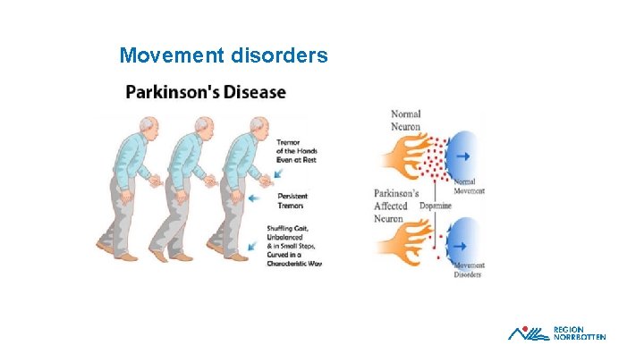 Movement disorders 