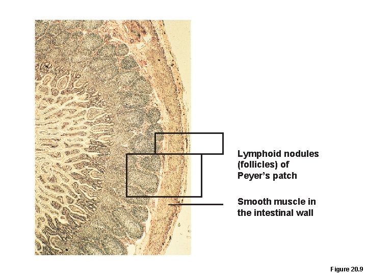 Lymphoid nodules (follicles) of Peyer’s patch Smooth muscle in the intestinal wall Figure 20.