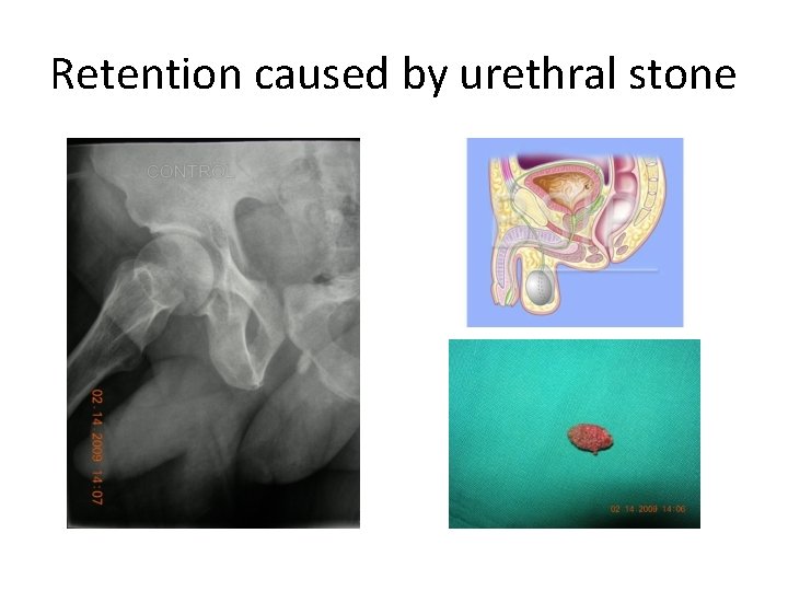 Retention caused by urethral stone 