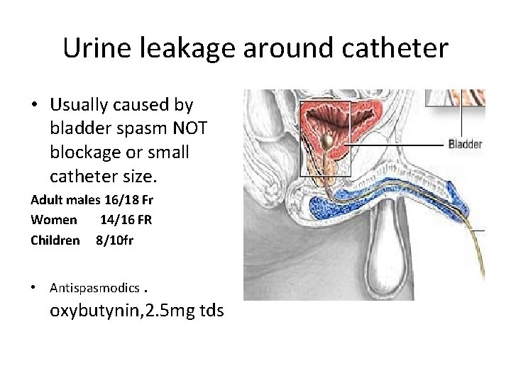 Urine leakage around catheter • Usually caused by bladder spasm NOT blockage or small