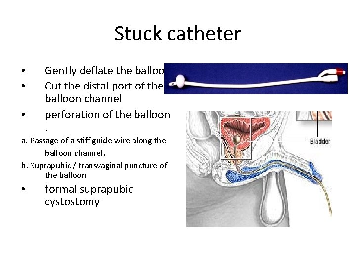 Stuck catheter • • • Gently deflate the balloon Cut the distal port of Stuck catheter • • • Gently deflate the balloon Cut the distal port of