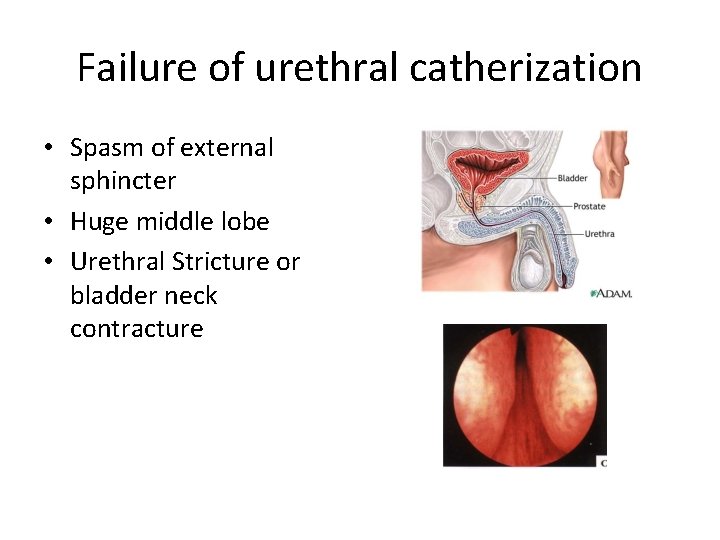 Failure of urethral catherization • Spasm of external sphincter • Huge middle lobe •