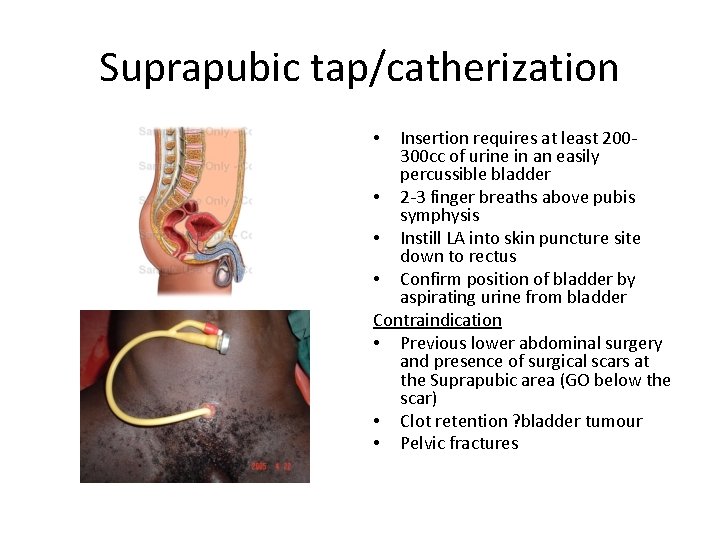Suprapubic tap/catherization Insertion requires at least 200300 cc of urine in an easily percussible