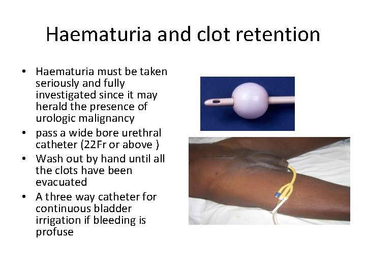 Haematuria and clot retention • Haematuria must be taken seriously and fully investigated since