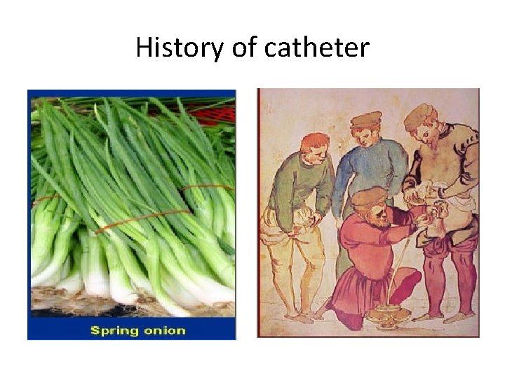 History of catheter 