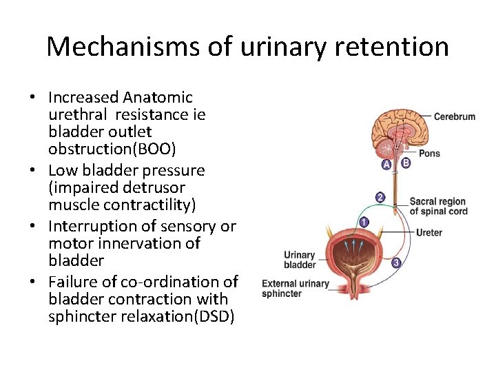 Mechanisms of urinary retention • Increased Anatomic urethral resistance ie bladder outlet obstruction(BOO) • Mechanisms of urinary retention • Increased Anatomic urethral resistance ie bladder outlet obstruction(BOO) •