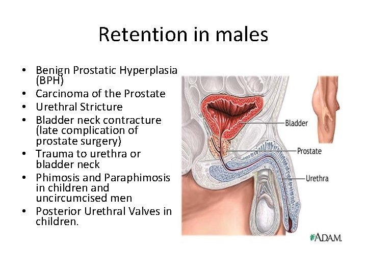 Retention in males • Benign Prostatic Hyperplasia (BPH) • Carcinoma of the Prostate •