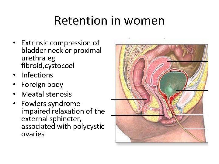 Retention in women • Extrinsic compression of bladder neck or proximal urethra eg fibroid,