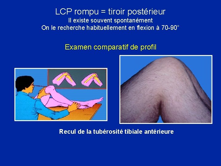 LCP rompu = tiroir postérieur Il existe souvent spontanément On le recherche habituellement en