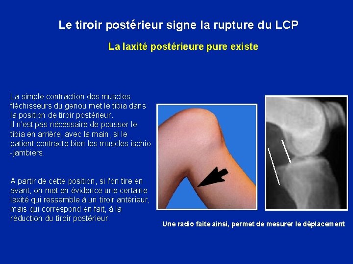 Le tiroir postérieur signe la rupture du LCP La laxité postérieure pure existe La