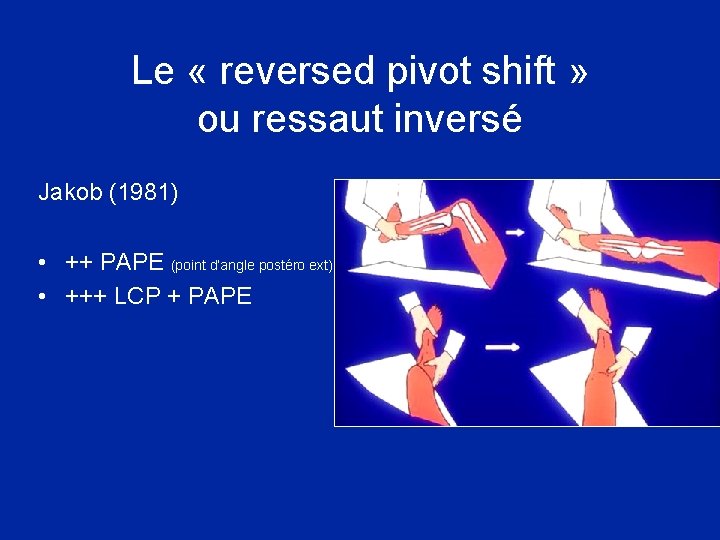 Le « reversed pivot shift » ou ressaut inversé Jakob (1981) • ++ PAPE