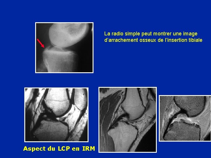 La radio simple peut montrer une image d’arrachement osseux de l’insertion tibiale Aspect du