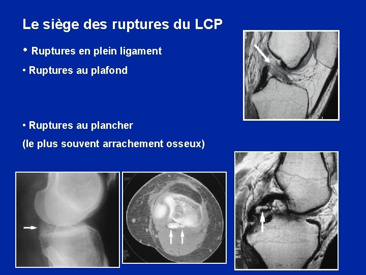 Le siège des ruptures du LCP • Ruptures en plein ligament • Ruptures au