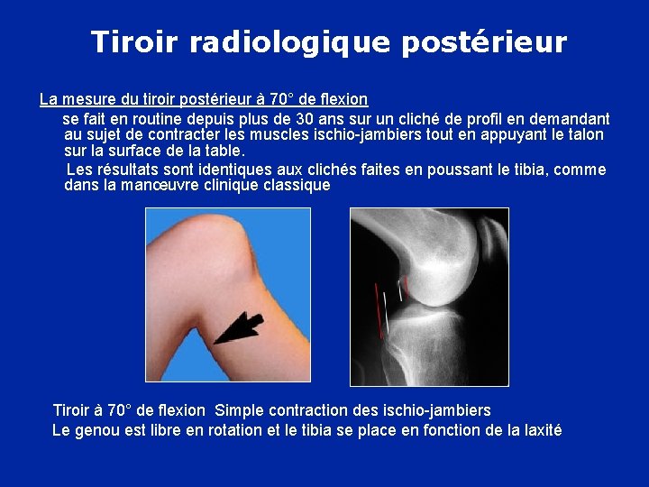 Tiroir radiologique postérieur La mesure du tiroir postérieur à 70° de flexion se fait