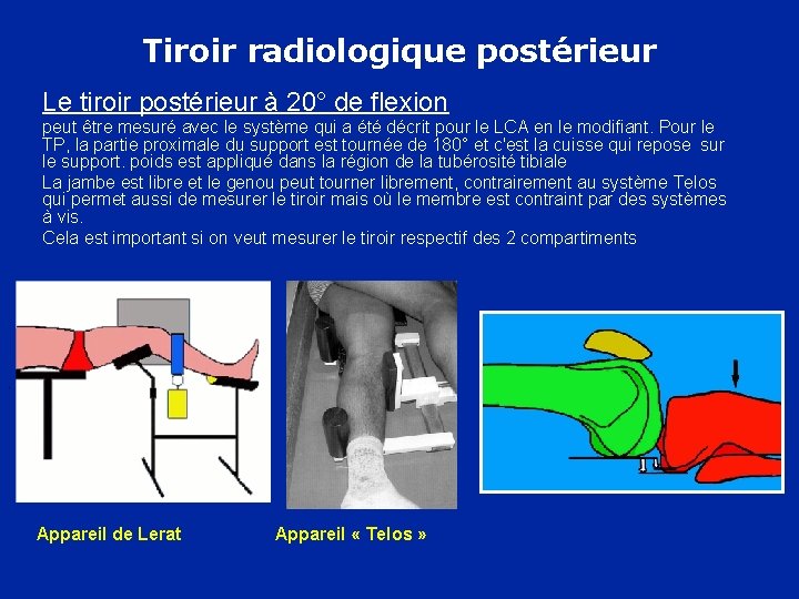 Tiroir radiologique postérieur Le tiroir postérieur à 20° de flexion peut être mesuré avec