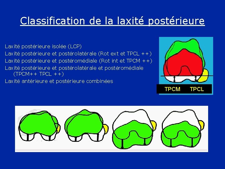 Classification de la laxité postérieure Laxité postérieure isolée (LCP) Laxité postérieure et postérolatérale (Rot