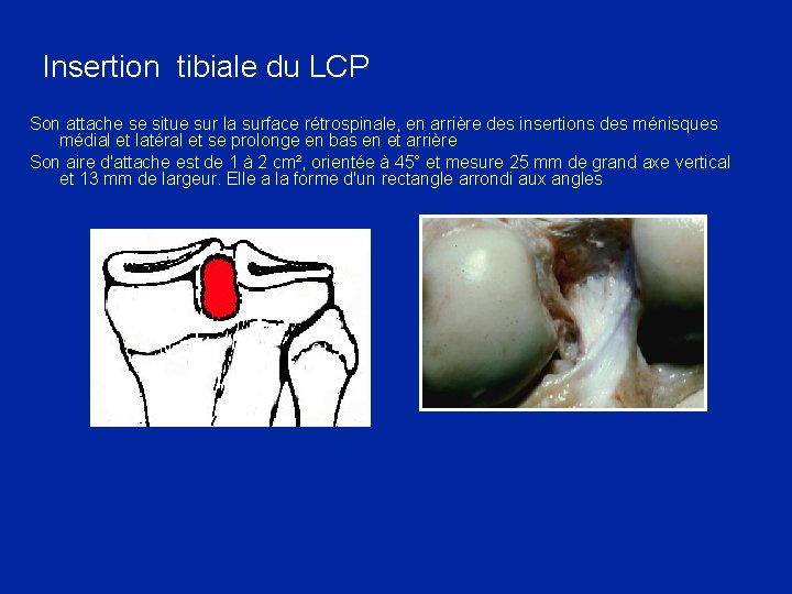 Insertion tibiale du LCP Son attache se situe sur la surface rétrospinale, en arrière