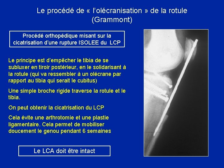 Le procédé de « l’olécranisation » de la rotule (Grammont) Procédé orthopédique misant sur